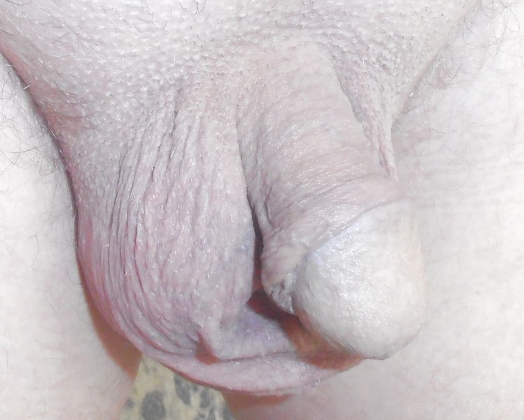 File:Banjaxed1 - Non-erect circumcised penis.jpeg