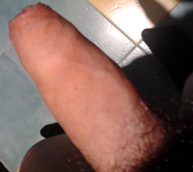 File:Pn994 - Penis uncirc.jpeg